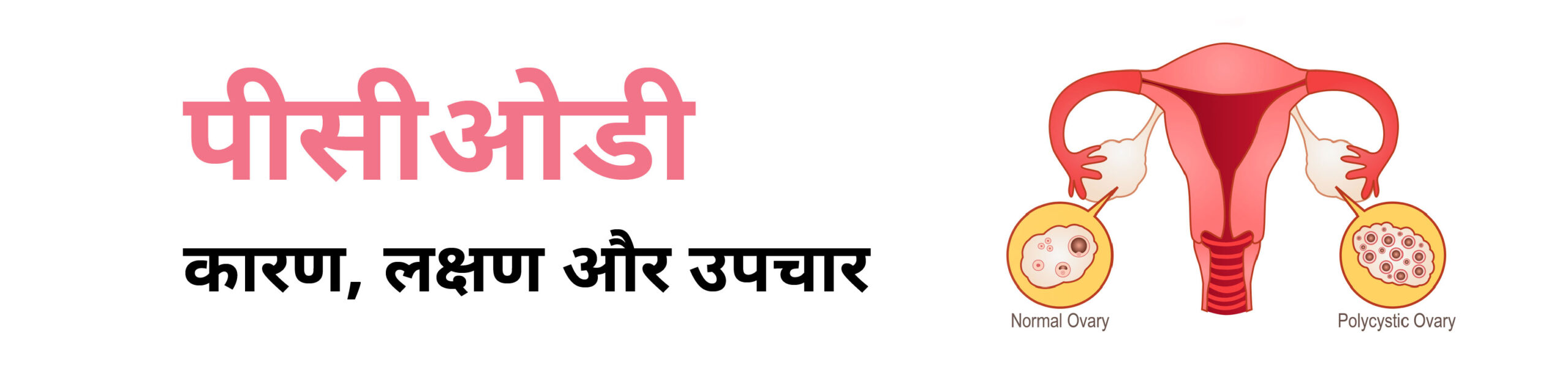 PCOD in Hindi: पीसीओडी क्या है, लक्षण और इलाज (PCOD: What It Is, Symptoms, and Treatment)